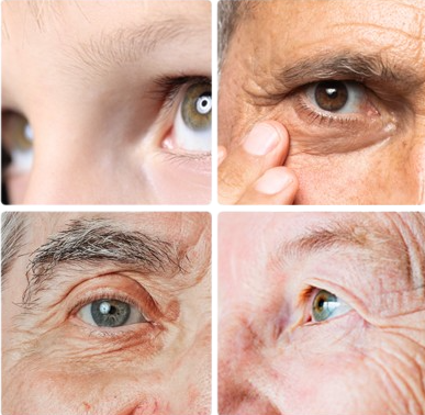 Sequencia de pessoas com catarata