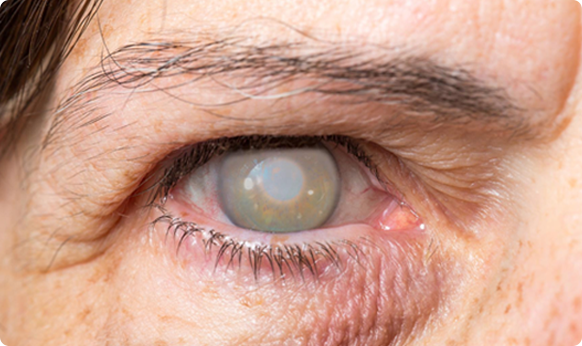 imagem sobre a cirurgia de catarata